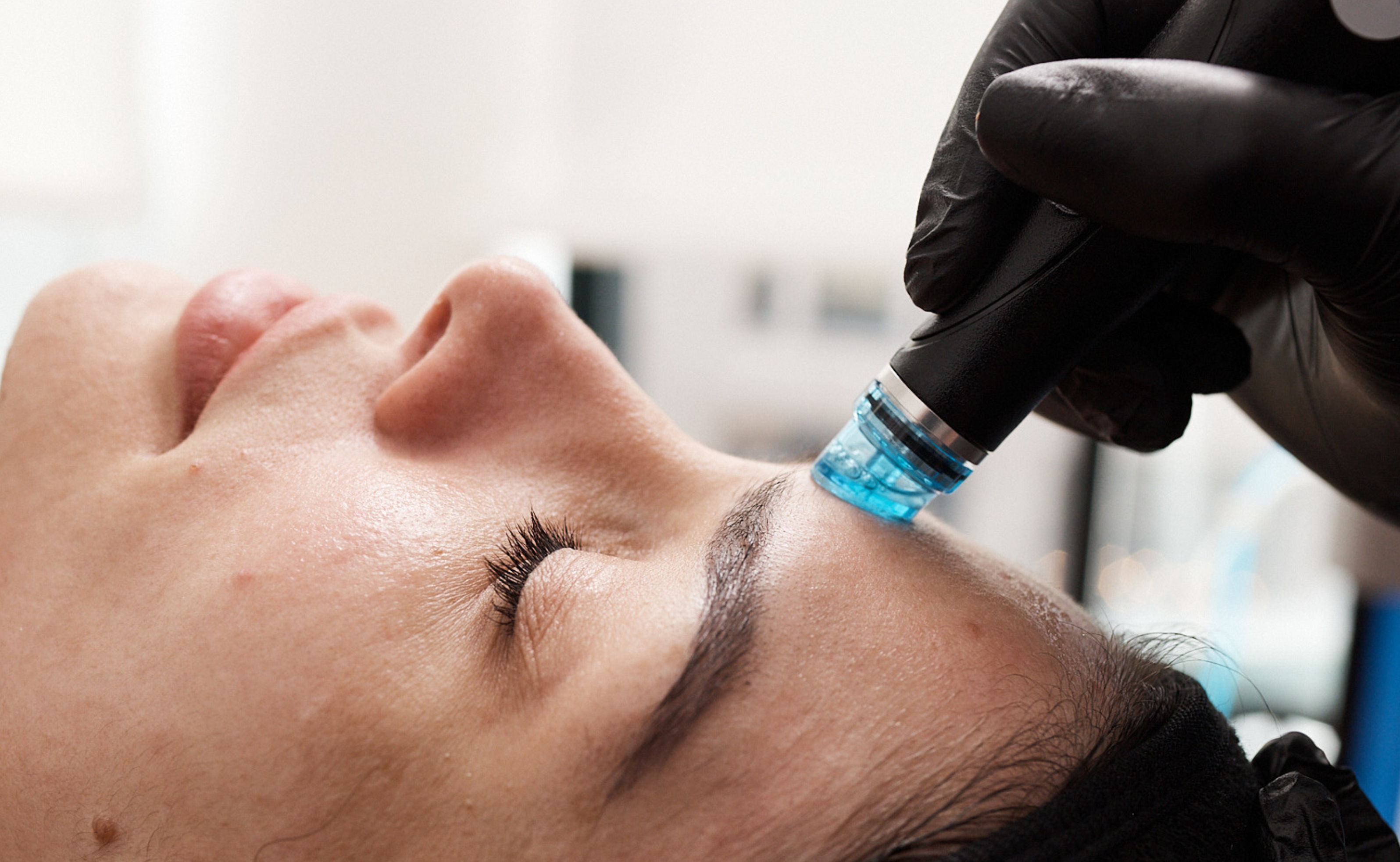 What Is the Best Facial for Acne?