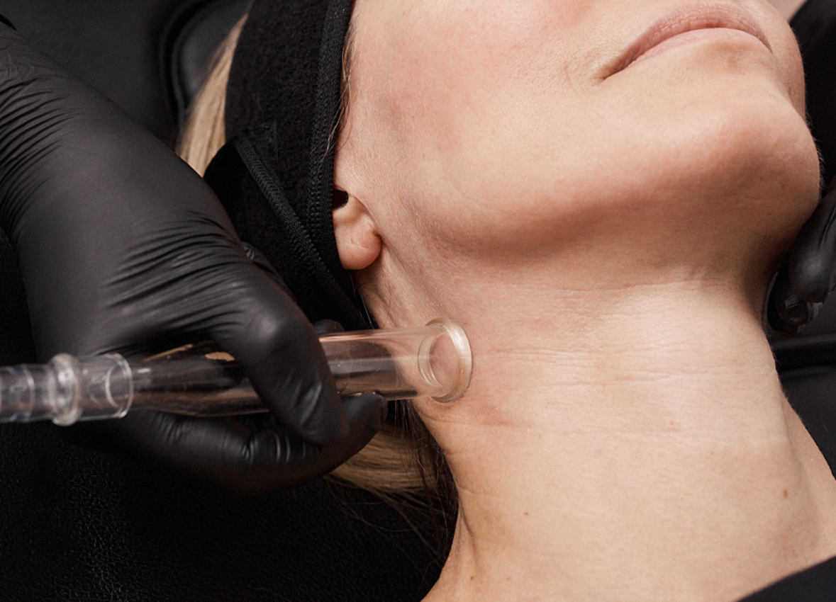 Close-up of a Hydrafacial treatment being performed on a woman’s neck. A provider wearing black gloves applies a clear suction wand along the jawline and throat to stimulate lymphatic drainage.