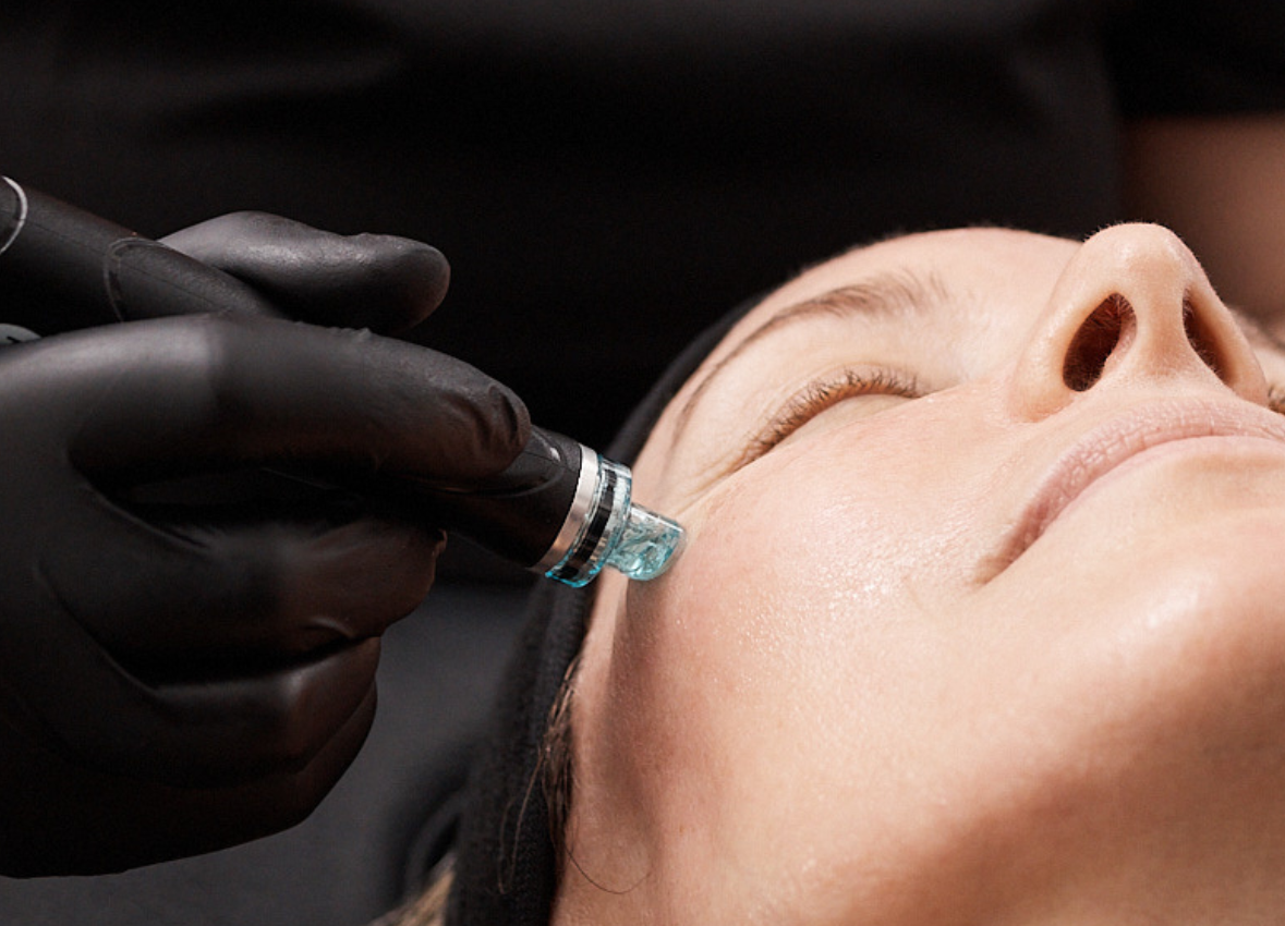 Close-up of a Hydrafacial device with a turquoise tip applied to a client’s cheek. The provider’s black-gloved hand steadies the skin while the treatment infuses serum and removes impurities.