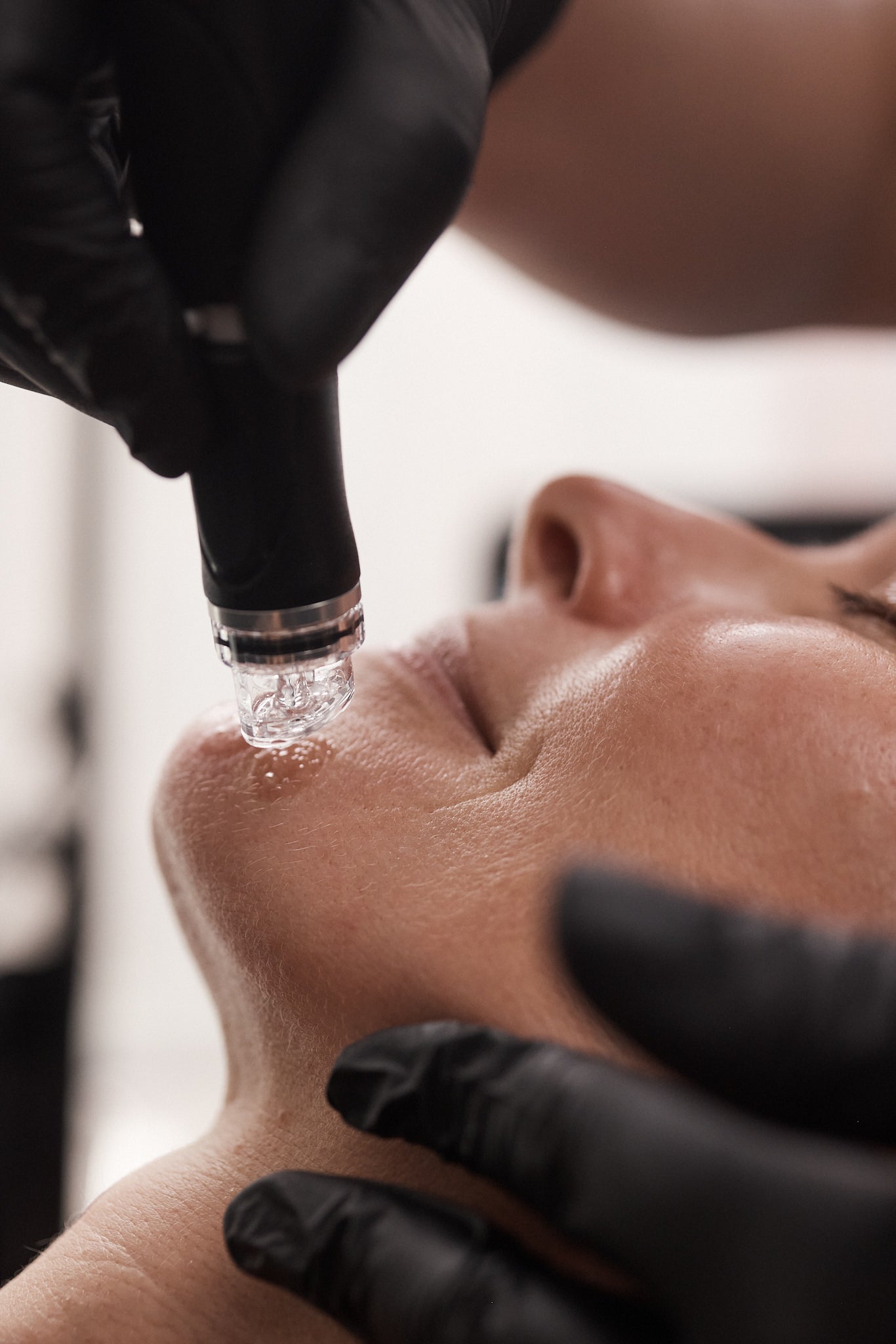 Close-up of a Hydrafacial device with a clear tip applied to a client’s chin during treatment, with the provider’s gloved hand steadying the area.