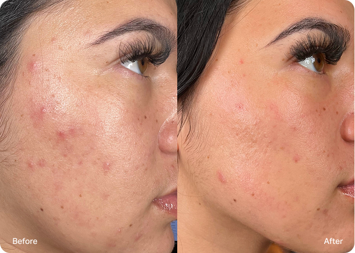 Side-by-side before-and-after comparison of a young woman with acne-prone skin. The “before” image shows multiple red blemishes and breakouts, while the “after” image shows clearer, smoother skin with reduced redness.