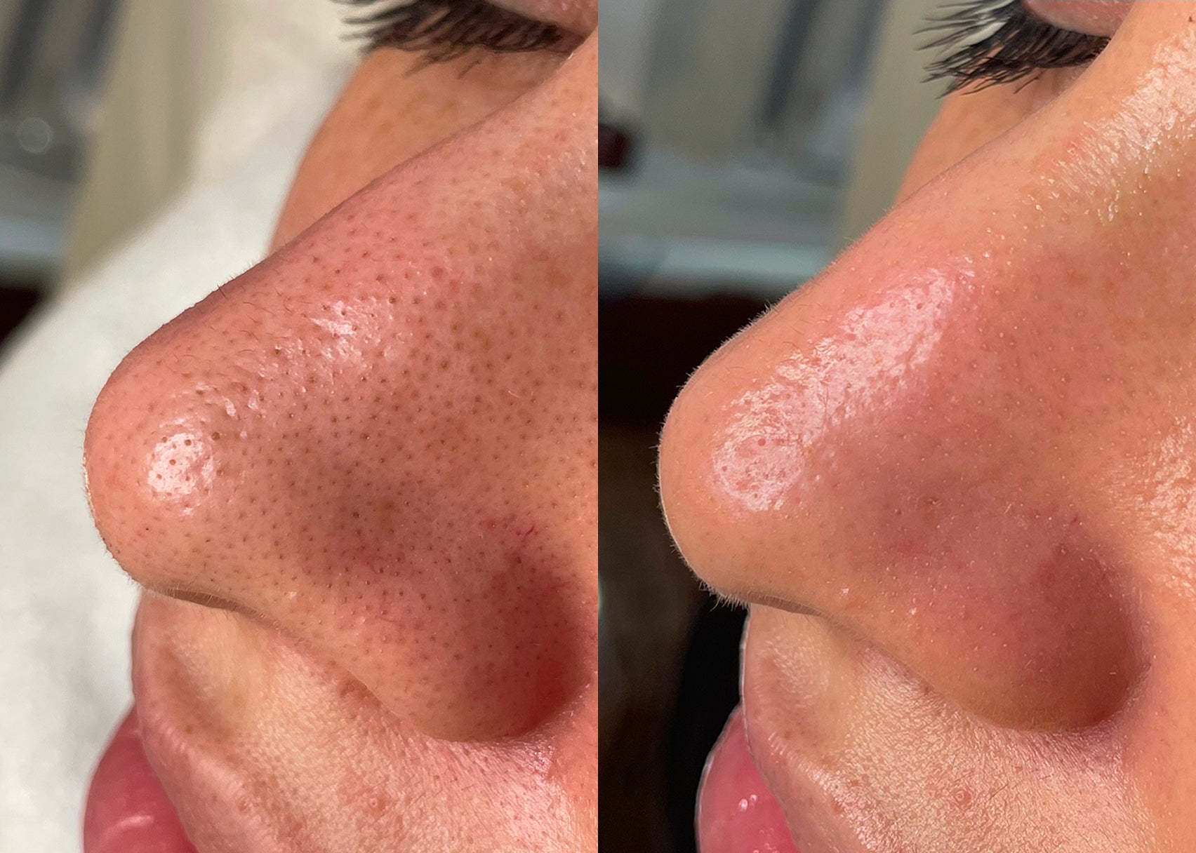 Side-by-side before-and-after image of a client’s nose, showing reduced blackheads and clearer skin after a Hydrafacial session.