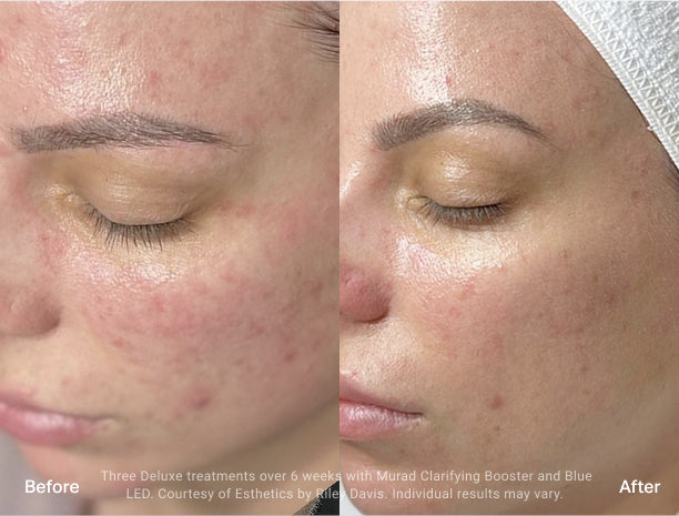 Side-by-side before-and-after comparison of a woman’s face following three Deluxe Hydrafacial treatments with Murad Clarifying Booster and blue LED light. The “before” image shows redness and active breakouts, while the “after” image shows calmer, clearer skin with less irritation.