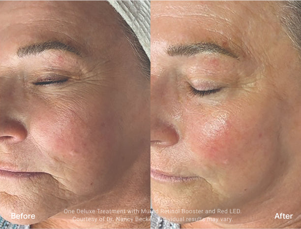 Side-by-side before-and-after comparison of a woman’s face following one Deluxe Hydrafacial treatment with Murad Retinol Booster and red LED light. The “before” side shows visible fine lines and uneven texture, while the “after” side shows smoother, more radiant skin.