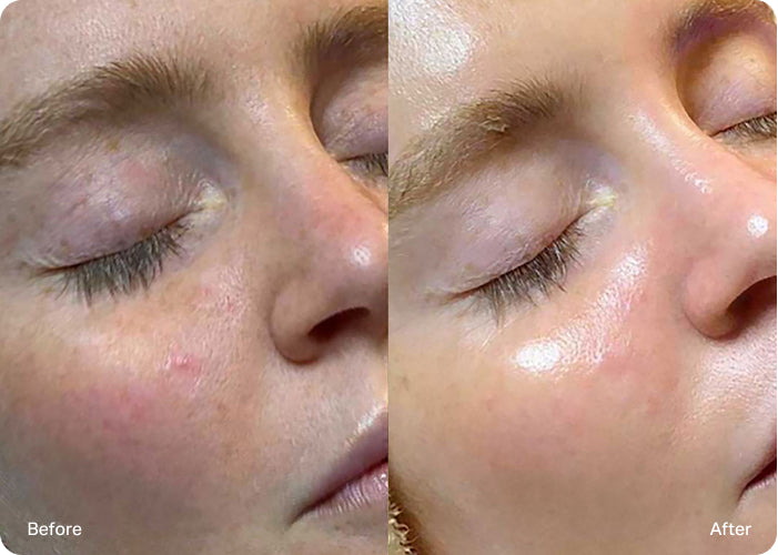 Side-by-side comparison of a woman's face before and after treatment, with visible changes in tone and fine lines.