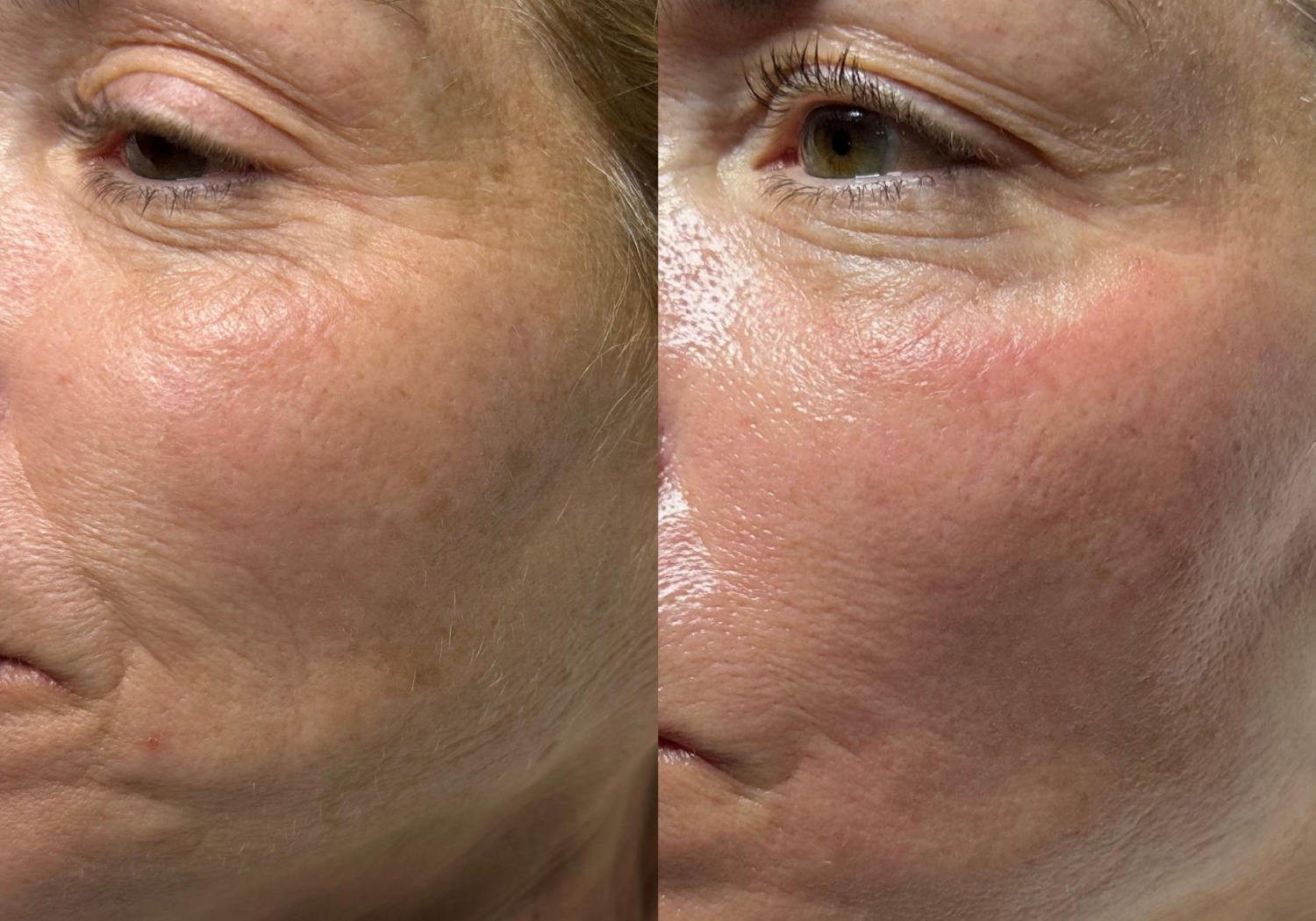 Side-by-side comparison of a woman’s cheek area before and after treatment, showing differences in fine lines and wrinkles.