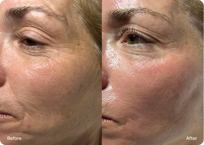 Side-by-side comparison of a woman’s cheek area before and after treatment, showing differences in fine lines and wrinkles