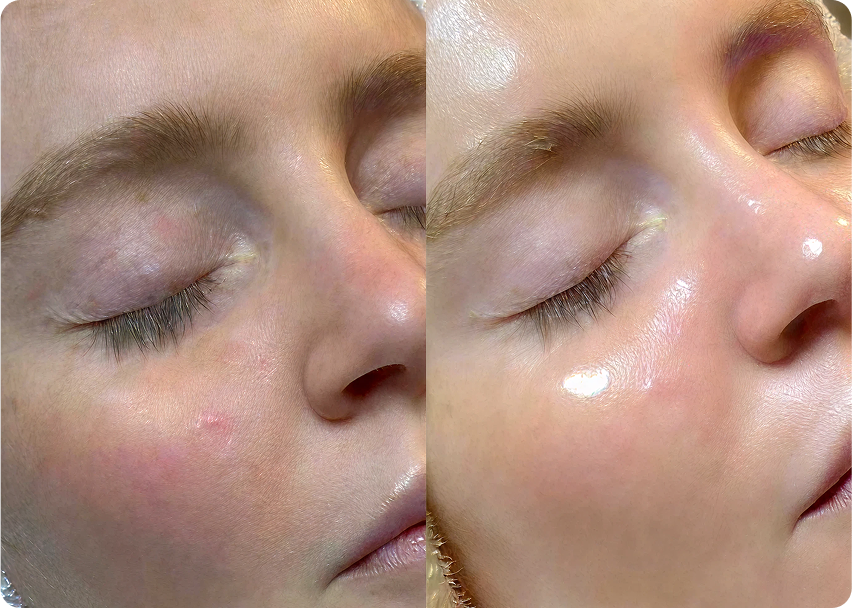 Side-by-side comparison of a woman's face before and after treatment, with visible changes in tone and fine lines.