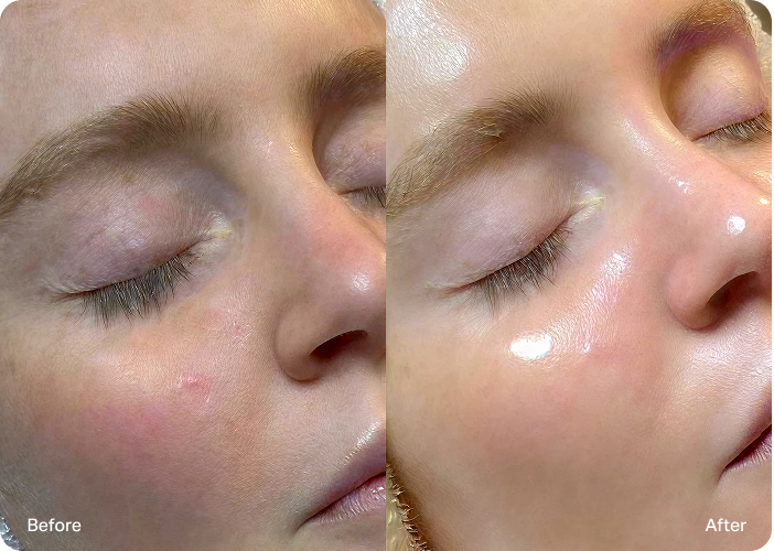 Side-by-side comparison of a woman's face before and after treatment, with visible changes in tone and fine lines.