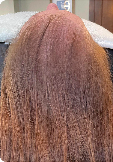 Top-down view of a client’s scalp showing thinning hair at the crown, with longer hair framing the sides and back.