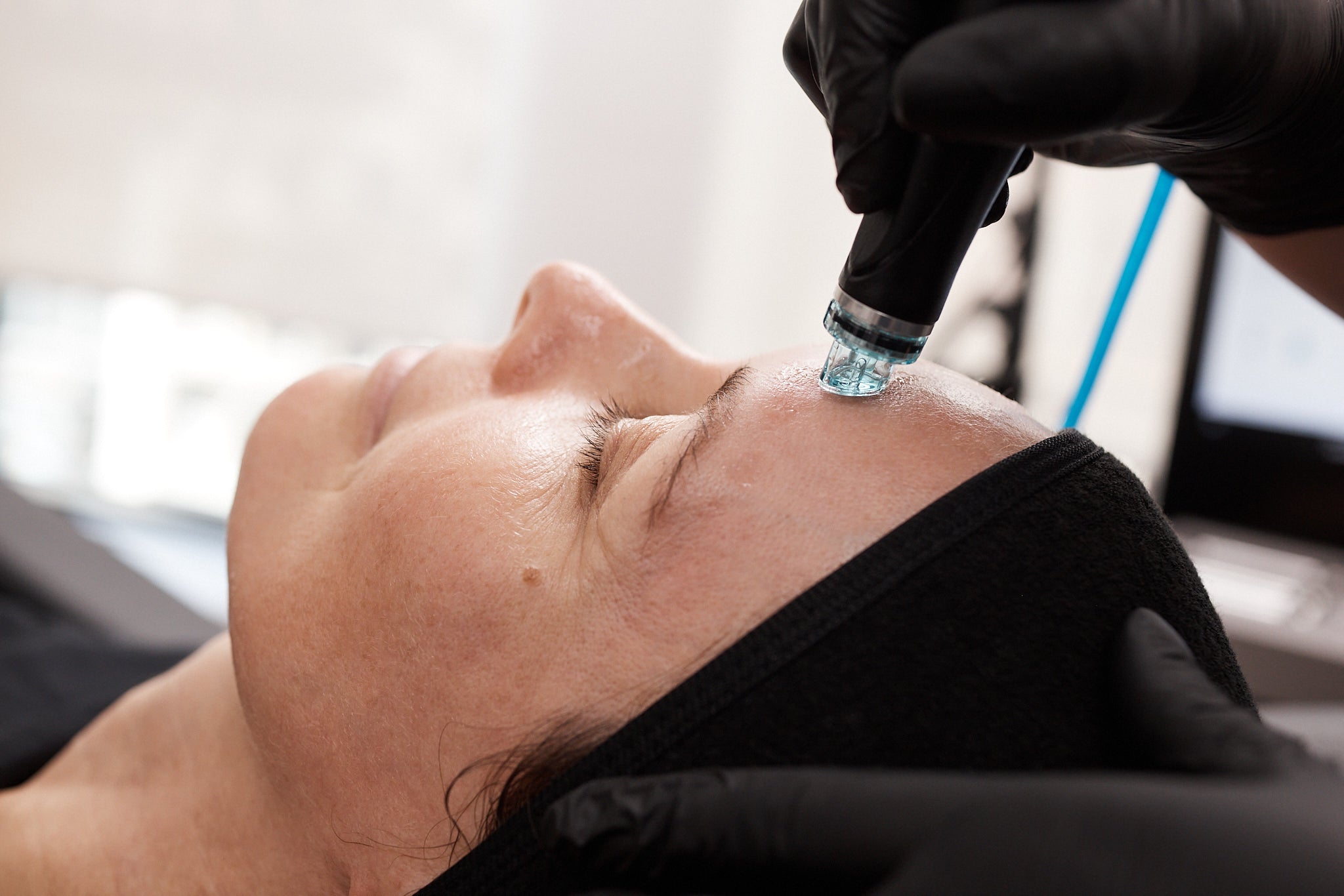 Close-up of a Hydrafacial device with a blue tip applied to the forehead area for targeted exfoliation and serum infusion.