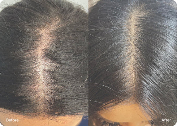 Side-by-side before-and-after comparison of the scalp. The left image shows visible thinning and wider part lines, while the right image shows fuller, denser hair coverage.