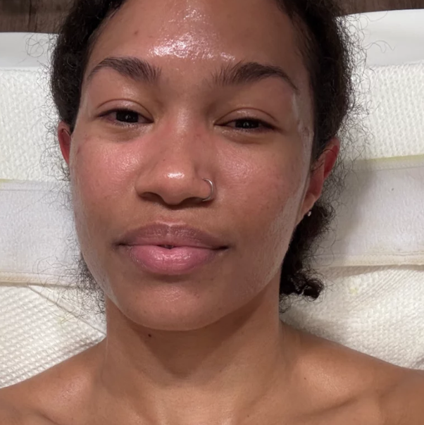 A woman taking a close-up photo immediately after treatment, her skin dewy and hydrated.