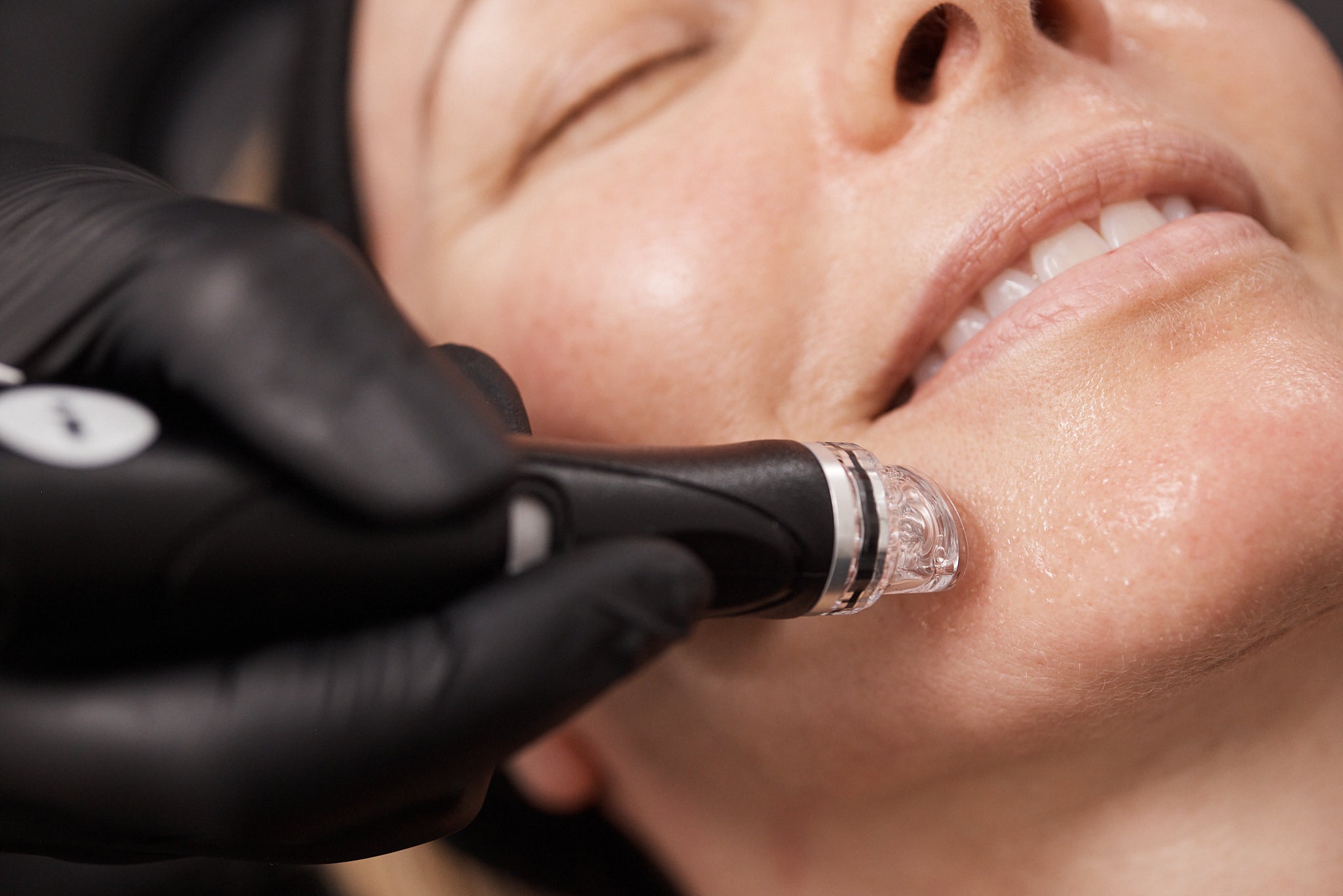 Close-up of Hydrafacial treatment on lower cheek with handheld device exfoliating and hydrating the skin.