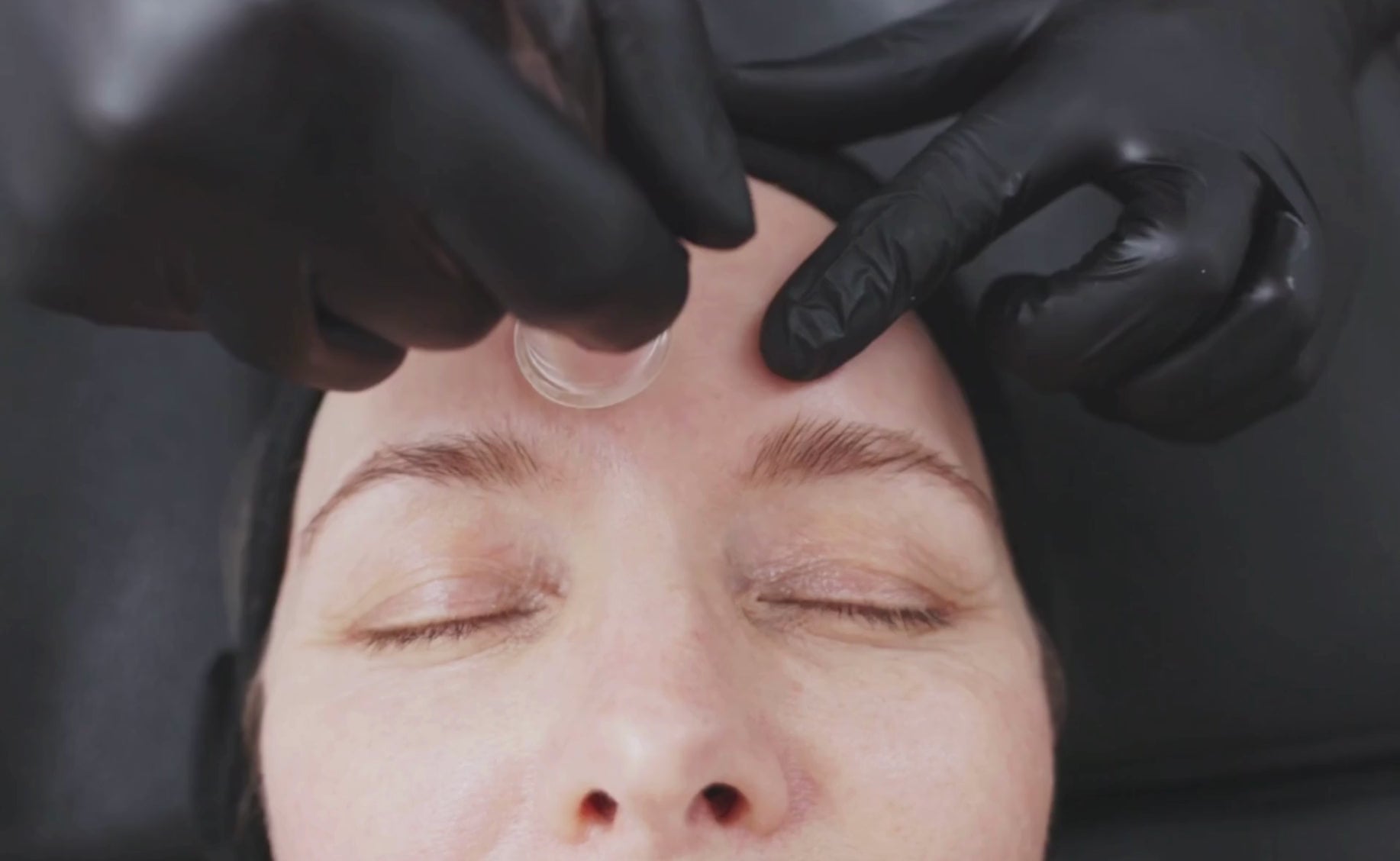 A gloved hand presses a round glass suction tip on the center of a client’s forehead.