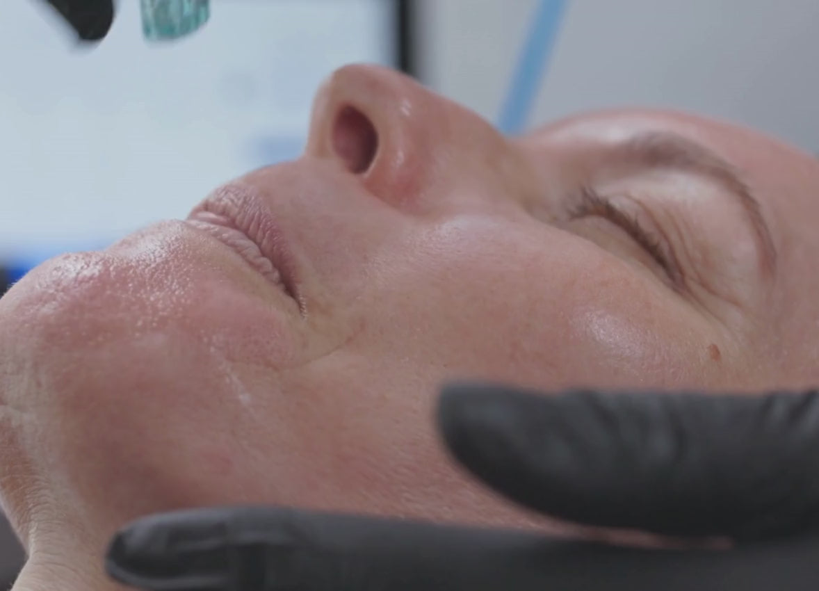 Close-up of a Hydrafacial treatment being applied to a client’s chin, showing smooth, hydrated skin and gloved hands holding the device.
