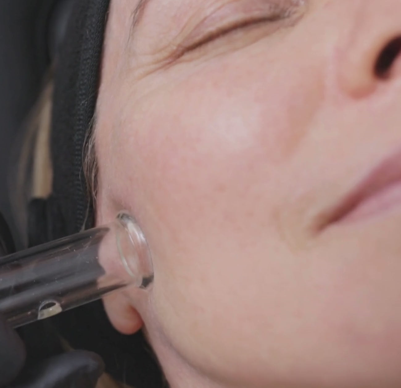 A practitioner in black gloves uses a clear glass tube on the side of a woman’s face near the temple as part of a Hydrafacial treatment.