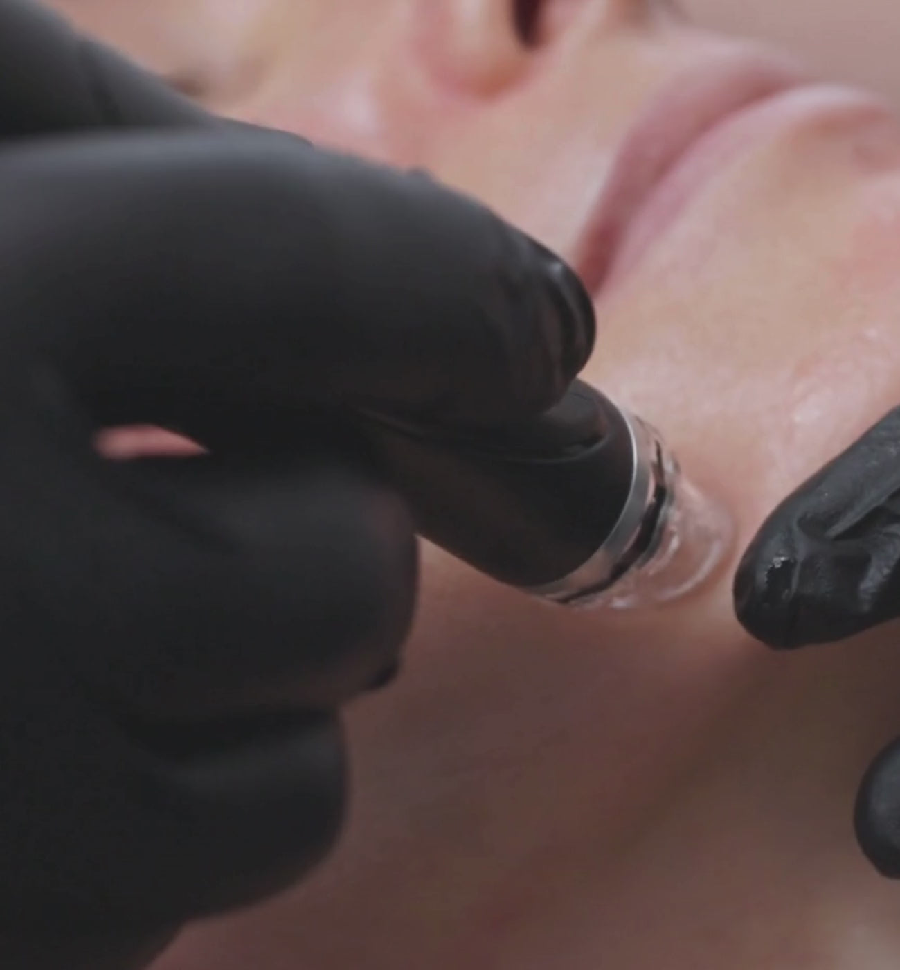 Close-up of a Hydrafacial handpiece working on a client’s chin. The black-gloved provider guides the device to exfoliate and infuse serum into the lower face.