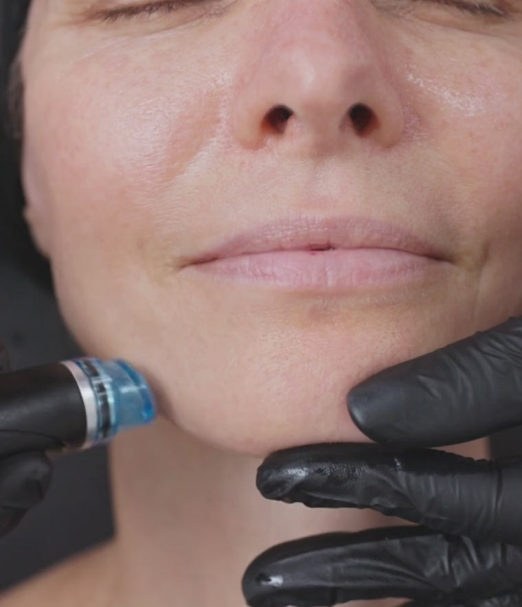 Close-up of the lower half of a client’s face, focusing on the chin and mouth area. A Hydrafacial device with a turquoise tip is being applied, while a gloved hand gently supports the chin.