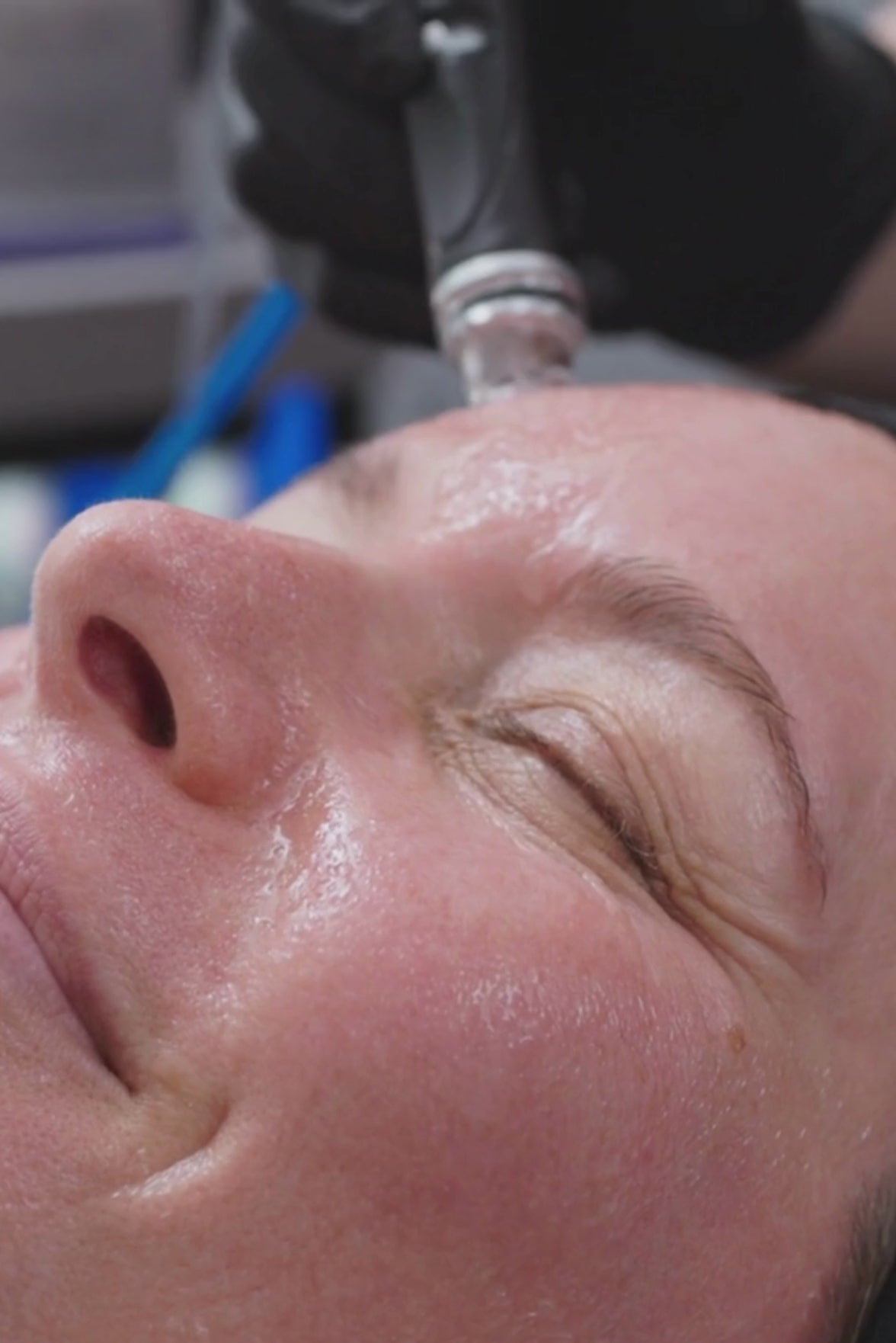 A Hydrafacial device tip glides across a client’s forehead during treatment. The client’s skin is hydrated and glistening as the spiral tip exfoliates and infuses serum simultaneously.